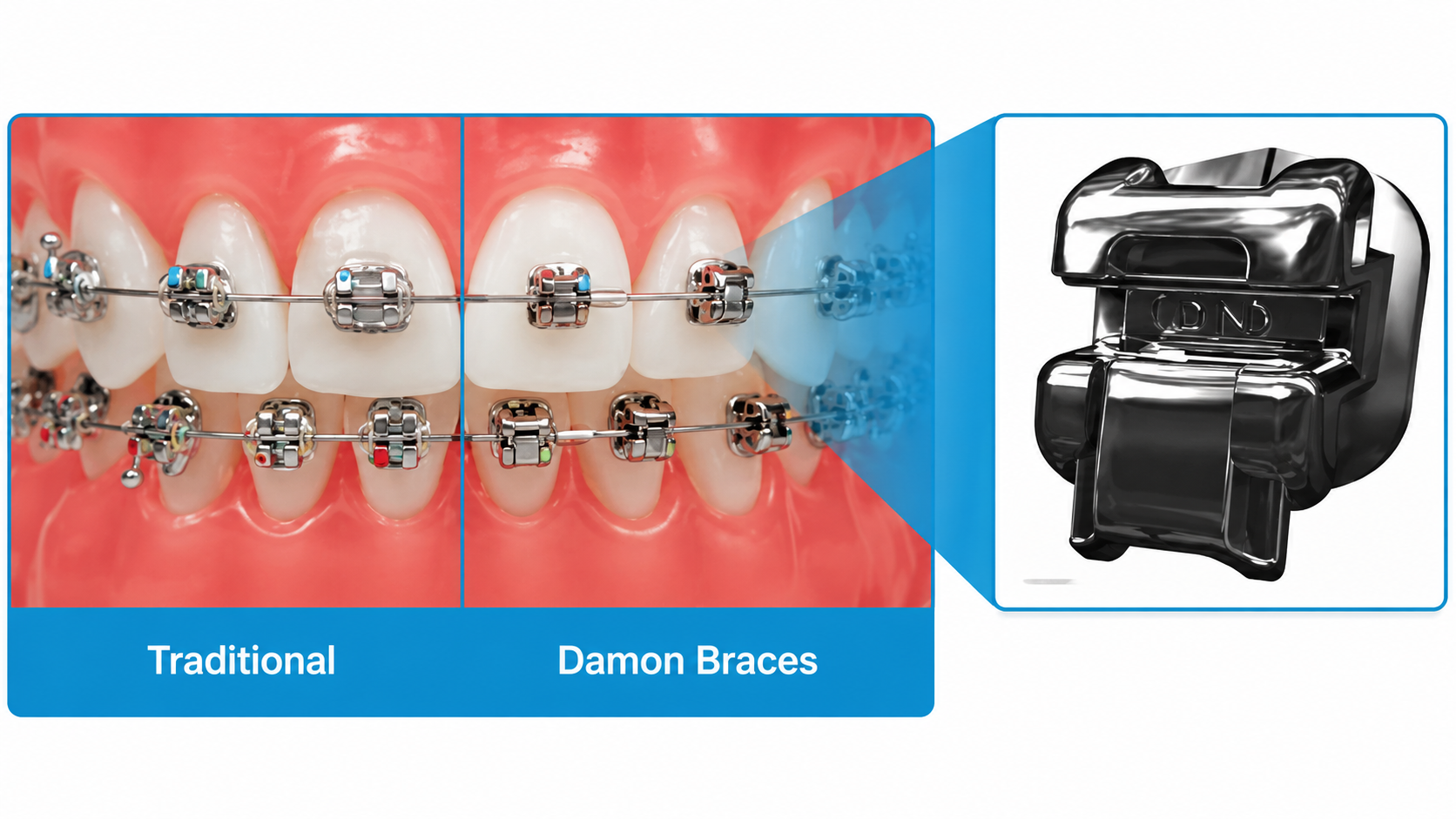 Damon Braces System
